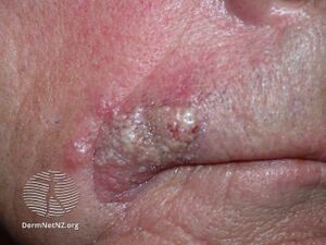 Sebaceous carcinoma (DermNet NZ lesions-sebaceous-ca-1).jpg