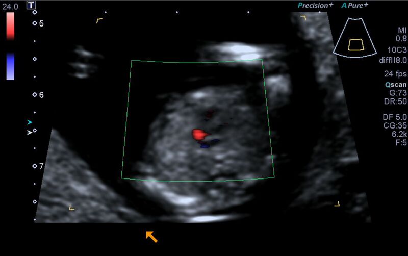 File:1st trimester nuchal-morphology ultrasound (Radiopaedia 44706-48477 Heart views cine with colour 126).jpg
