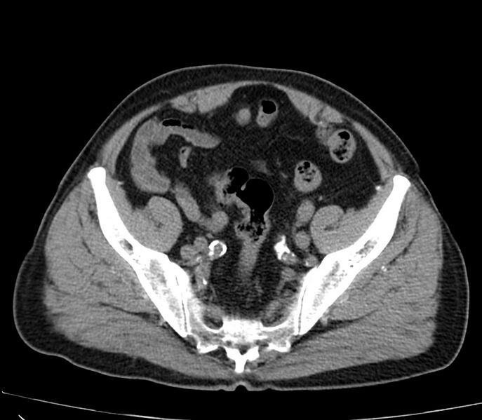 File:Abdominal aortic aneurysm (Radiopaedia 22421-22458 non-contrast 45).jpg