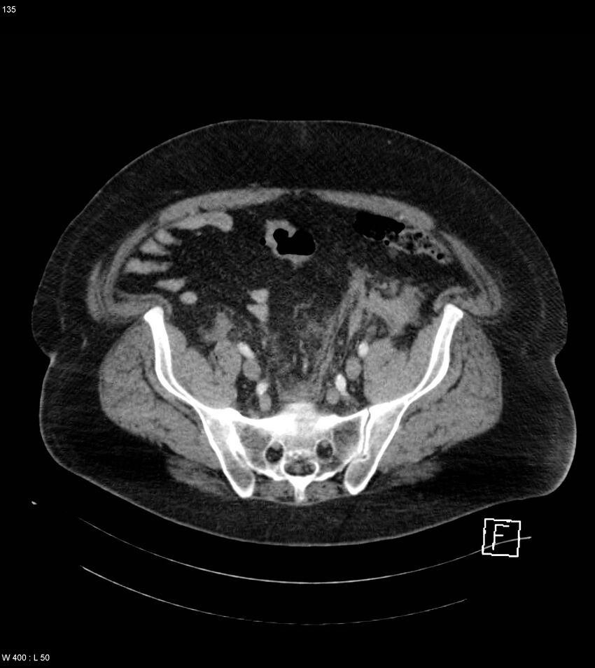 Abdominal aortic aneurysm with intramural hematoma then rupture (Radiopaedia 50278-55632 Axial C+ arterial phase 134).jpg