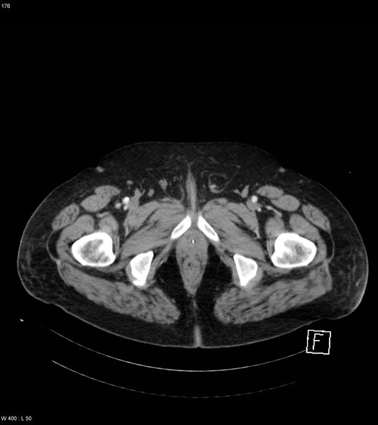 File:Abdominal aortic aneurysm with intramural hematoma then rupture (Radiopaedia 50278-55632 Axial C+ arterial phase 175).jpg