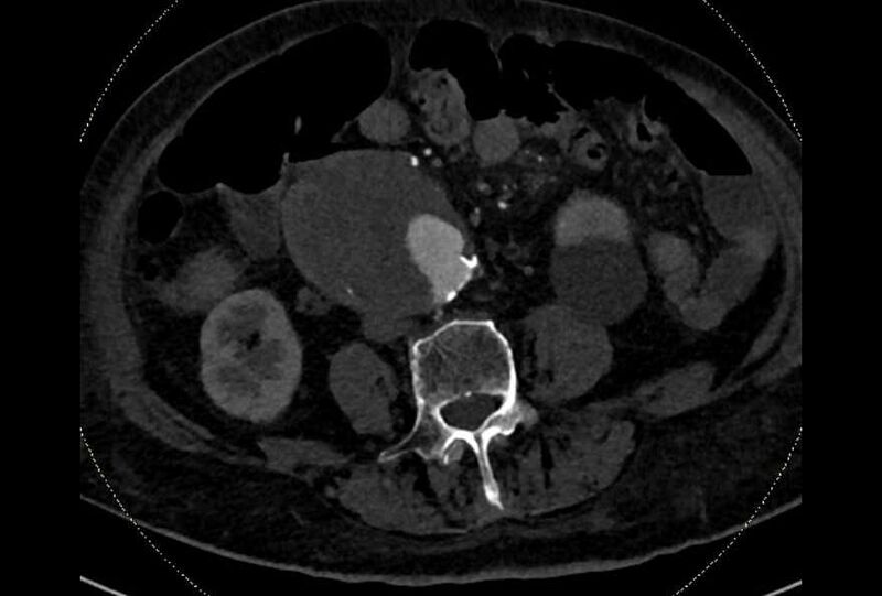 File:Abdominal aortic aneurysm with thrombus fissuration (Radiopaedia 73192-83919 Axial C+ arterial phase 125).jpg