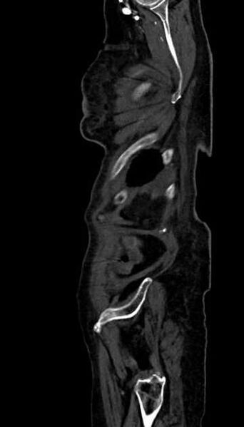 File:Abdominal aortic aneurysm with thrombus fissuration (Radiopaedia 73192-83919 Sagittal C+ arterial phase 4).jpg