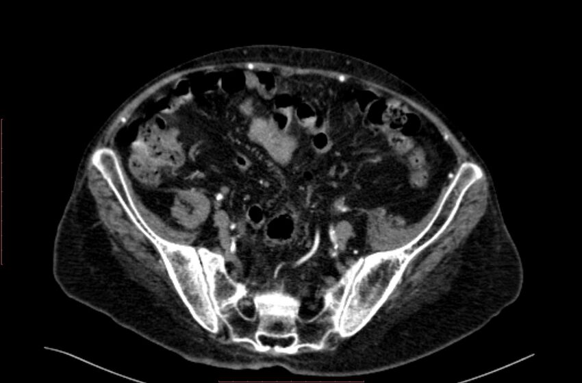 Abdominal aortic interposition tube graft and aneurysm thrombosis (Radiopaedia 71438-81857 Axial C+ arterial phase 170).jpg