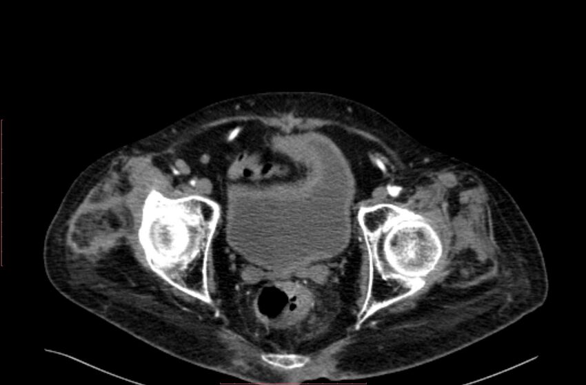 Abdominal aortic interposition tube graft and aneurysm thrombosis (Radiopaedia 71438-81857 Axial C+ arterial phase 220).jpg