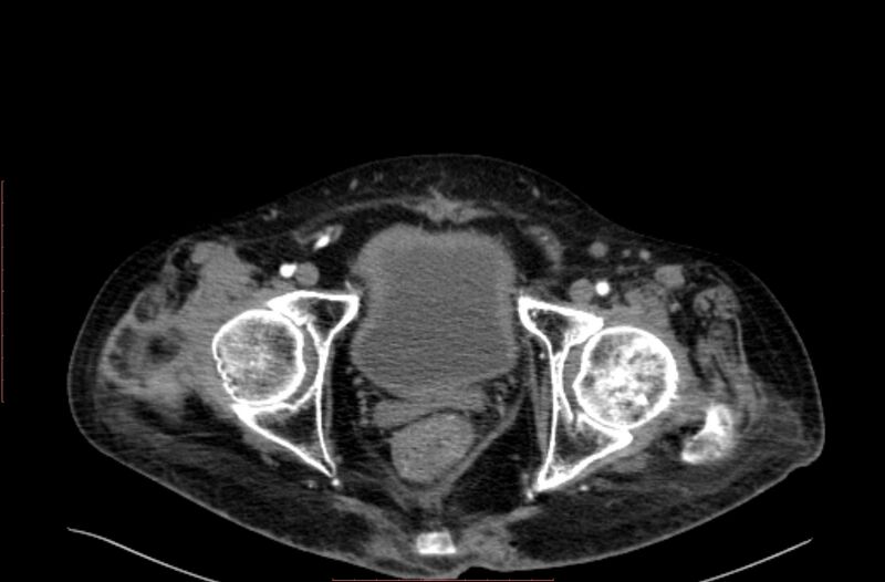 File:Abdominal aortic interposition tube graft and aneurysm thrombosis (Radiopaedia 71438-81857 Axial C+ arterial phase 230).jpg