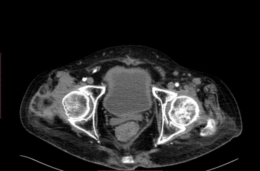 Abdominal aortic interposition tube graft and aneurysm thrombosis (Radiopaedia 71438-81857 Axial C+ arterial phase 230).jpg
