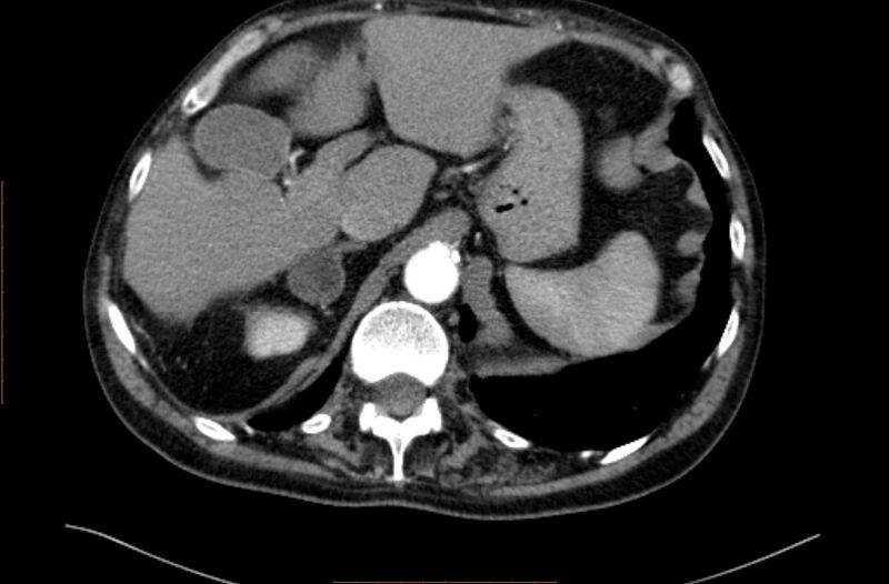 File:Abdominal aortic interposition tube graft and aneurysm thrombosis (Radiopaedia 71438-81857 Axial C+ arterial phase 6).jpg