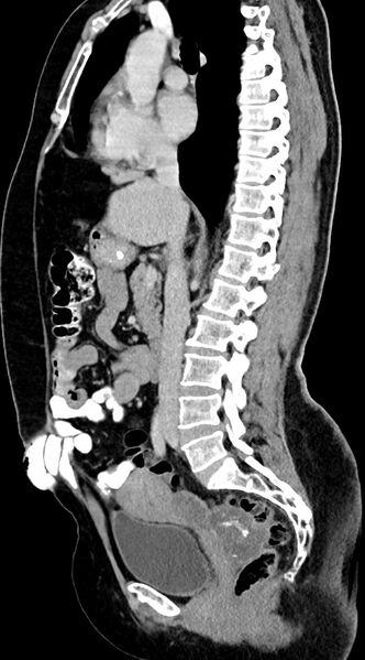 File:Abdominal hydatid disease (Radiopaedia 68223-77737 Sagittal C+ portal venous phase 38).jpg