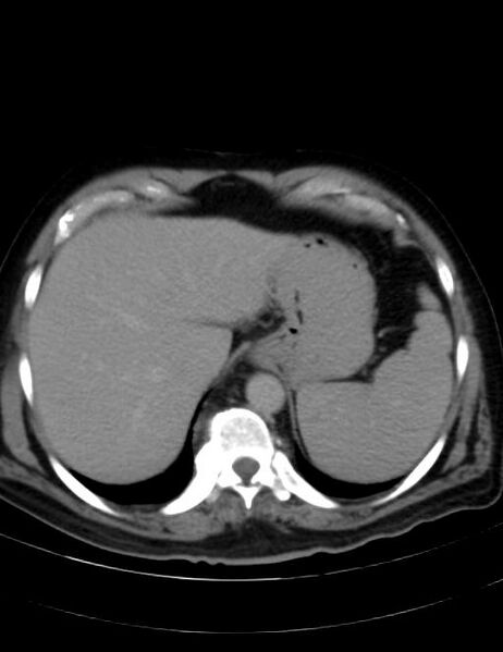 File:Abdominal lymphoma - with sandwich sign (Radiopaedia 53486-59492 Axial C+ portal venous phase 8).jpg