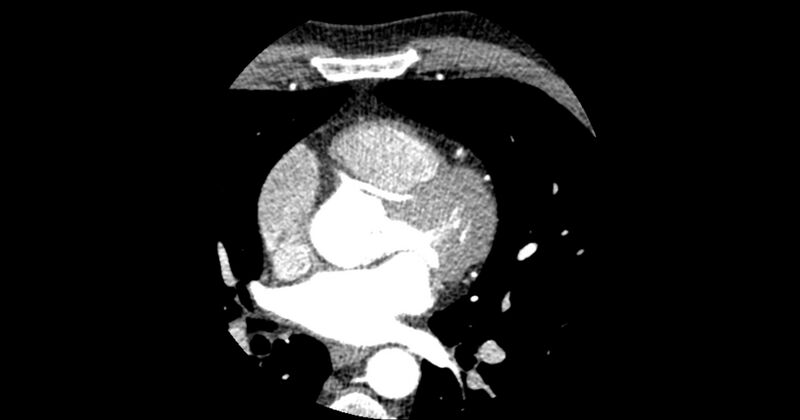 File:Aberrant left main coronary artery (ALMCA) arising from the right sinus with interarterial course (Radiopaedia 63251-71814 Axial C+ arterial phase 73).JPG