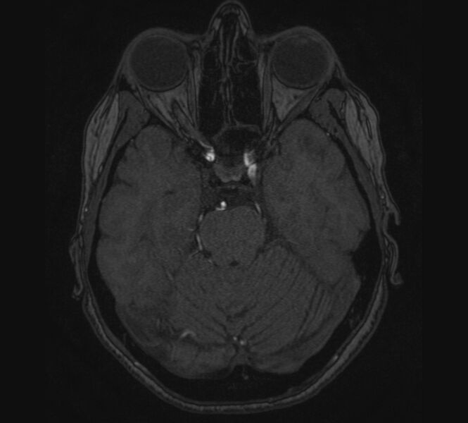 File:Accessory middle cerebral artery and ICA aneurysm (Radiopaedia 22656-22674 MRA 33).jpg