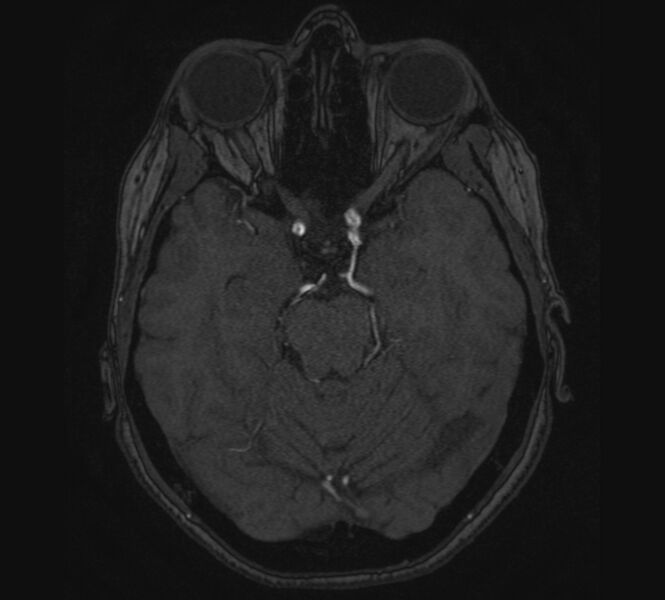 File:Accessory middle cerebral artery and ICA aneurysm (Radiopaedia 22656-22674 MRA 38).jpg