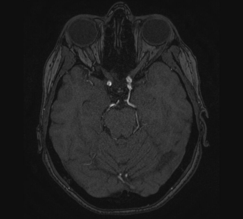 Accessory middle cerebral artery and ICA aneurysm (Radiopaedia 22656-22674 MRA 38).jpg