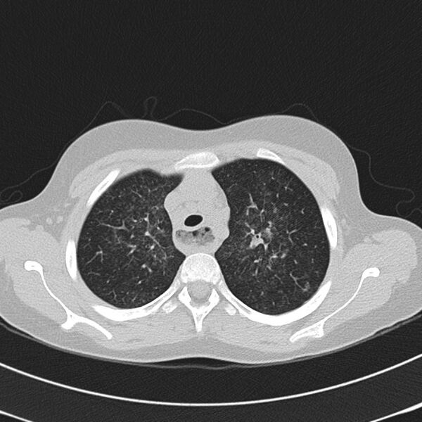 File:Achalasia (Radiopaedia 14946-14878 Axial lung window 16).jpg