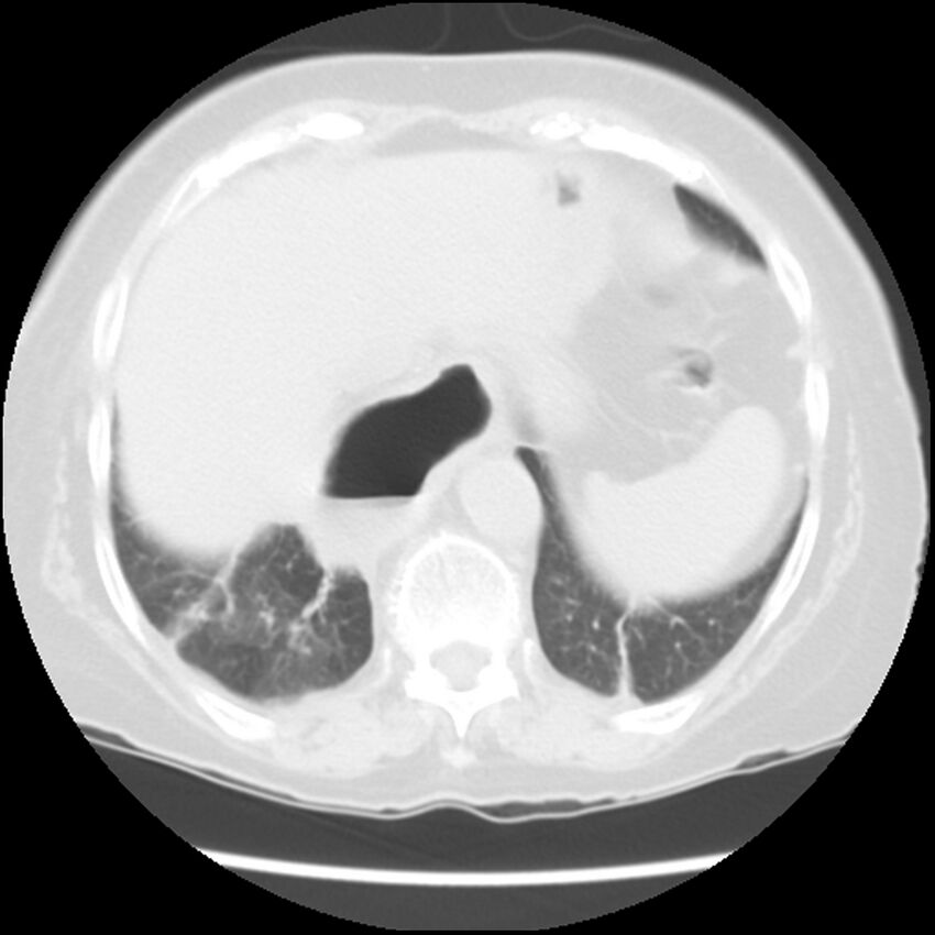 Achalasia (Radiopaedia 44094-47649 Axial lung window 48).jpg