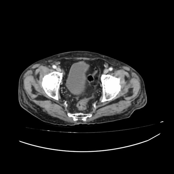 File:Acute-on-chronic Crohn disease with enteroenteric fistula (Radiopaedia 66686-75987 B 75).jpg