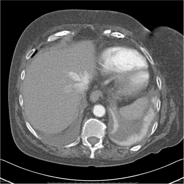 File:Acute-on-chronic pulmonary emboli (Radiopaedia 27925-28169 C+ CTPA 68).jpg