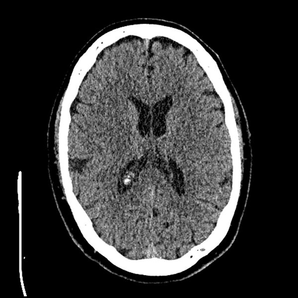 File:Acute A3 occlusion with ACA ischemic penumbra (CT perfusion) (Radiopaedia 72036-82525 Axial non-contrast thins 53).jpg