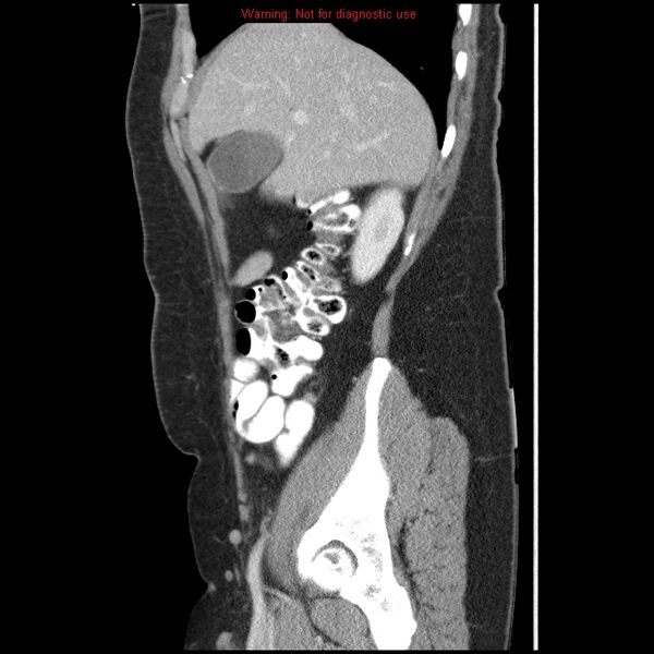 File:Acute appendicitis (Radiopaedia 7966-8812 B 10).jpg