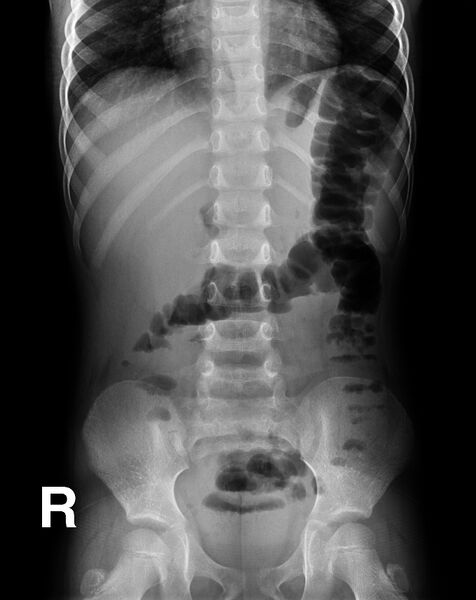 File:Acute appendicitis (Radiopaedia 9308-9992 Frontal 1).jpg