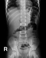 Acute appendicitis (Radiopaedia 9308-9992 Frontal 1).jpg