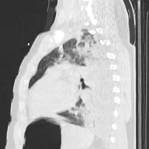 File:Acute aspiration pneumonitis (Radiopaedia 33605-34703 Sagittal lung window 56).jpg