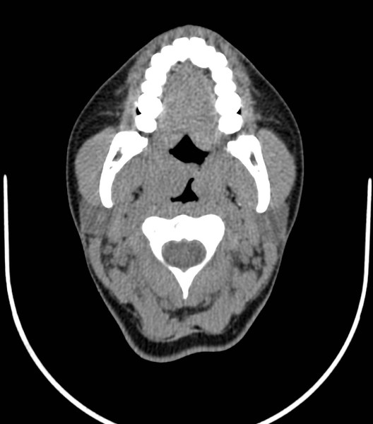 File:Acute bacterial tonsillitis (Radiopaedia 22882-22908 Axial non-contrast 16).png