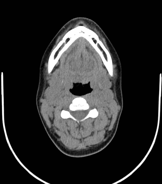 File:Acute bacterial tonsillitis (Radiopaedia 22882-22908 Axial non-contrast 27).png