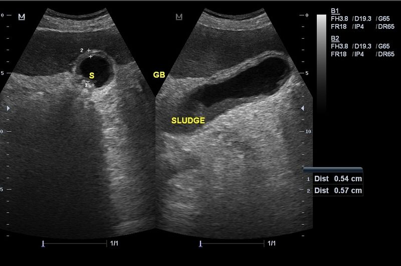 File:Acute calculous cholecystitis and bladder tumor (Radiopaedia 17032-16733 Left image transverse and the right is longitudinal 1).jpg