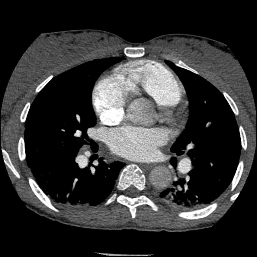 Acute chest syndrome - sickle cell disease (Radiopaedia 42375-45499 Axial C+ CTPA 97).jpg