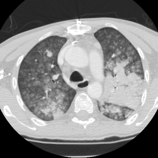 File:Acute diffuse alveolar hemorrhage (Radiopaedia 41323-44158 Axial lung window 18).jpg