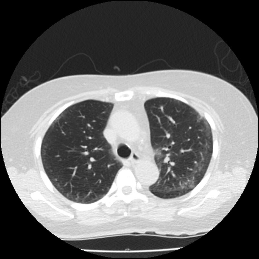 Acute interstitial pneumonitis (Radiopaedia 45404-49444 Axial lung window 36).jpg