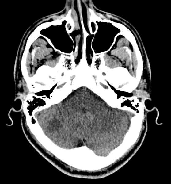 File:Acute ischemic stroke - posterior circulation territory (Radiopaedia 77670-89881 non-contrast 18).jpg