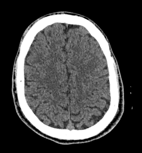 File:Acute ischemic stroke - posterior circulation territory (Radiopaedia 77670-89881 non-contrast 69).jpg
