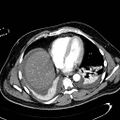 Acute pancreatic necrosis (Radiopaedia 13560-13486 Axial C+ portal venous phase 12).jpg