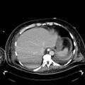 Acute pancreatic necrosis (Radiopaedia 13560-18503 Axial C+ portal venous phase 8).jpg