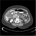 Acute pancreatitis (Radiopaedia 19136-19117 Axial C+ portal venous phase 19).jpg