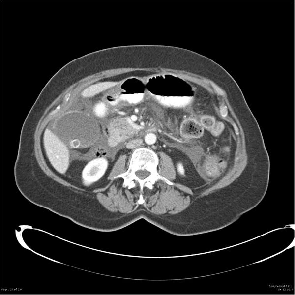 File:Acute pancreatitis (Radiopaedia 19136-19117 Axial C+ portal venous phase 19).jpg
