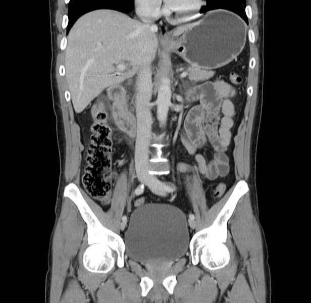 File:Acute pancreatitis (Radiopaedia 22572-22596 Coronal C+ portal venous phase 27).jpg