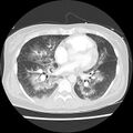 Acute pulmonary edema on CT (Radiopaedia 33582-34672 Axial lung window 32).jpg
