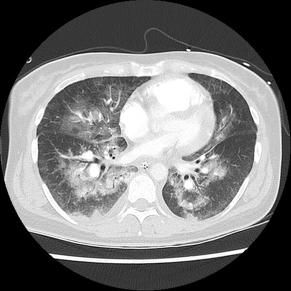 File:Acute pulmonary edema on CT (Radiopaedia 33582-34672 Axial lung window 32).jpg
