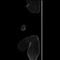 Acute pyelonephritis (Radiopaedia 25657-25837 Sagittal renal parenchymal phase 4).jpg