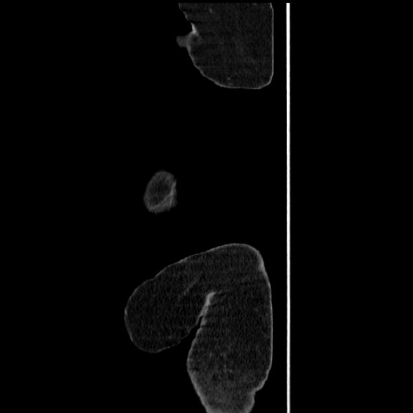 File:Acute pyelonephritis (Radiopaedia 25657-25837 Sagittal renal parenchymal phase 4).jpg