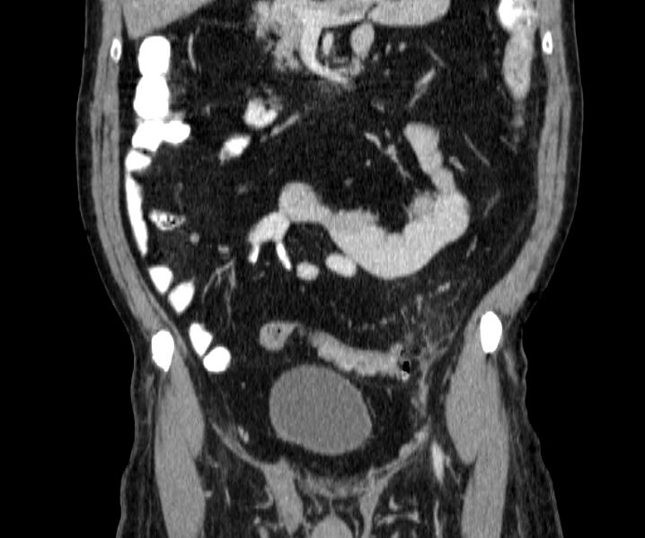 File:Acute sigmoid colon diverticulitis (Radiopaedia 55507-61976 Coronal C+ portal venous phase 54).jpg
