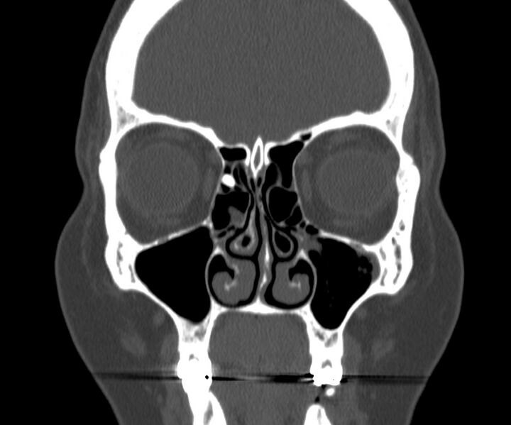 File:Acute sinusitis (Radiopaedia 22419-22455 Coronal bone window 14).jpg