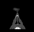 Acute sinusitis (Radiopaedia 23161-23215 Coronal bone window 15).jpg