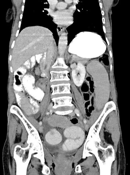 File:Acute small bowel (ileal) volvulus (Radiopaedia 71740-82139 Coronal C+ portal venous phase 65).jpg