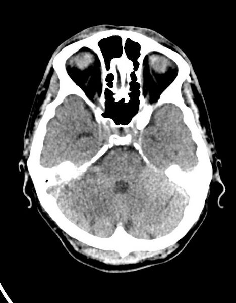 File:Acute superior cerebellar artery territory infarct (Radiopaedia 84104-99359 Axial non-contrast 48).jpg