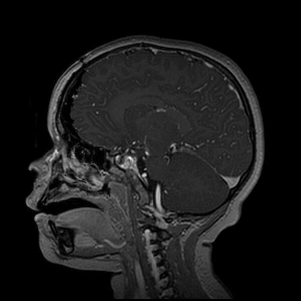 File:Adamantinomatous craniopharyngioma (Radiopaedia 77407-89529 H 53).jpg